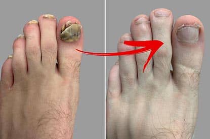 Nagelsvampsbehandling