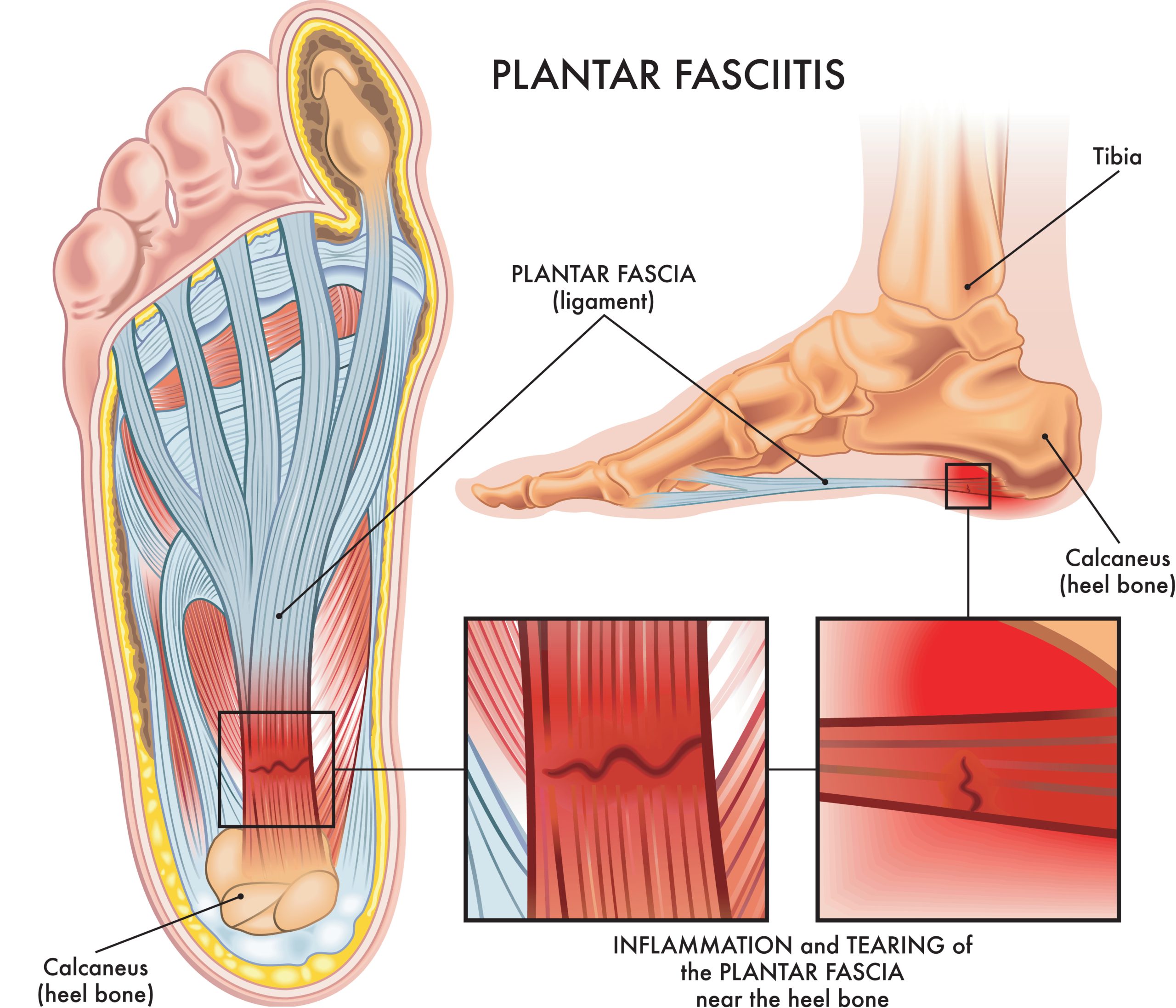 Plantar Fasciitis: Causes, Symptoms & Heel Pain Treatment